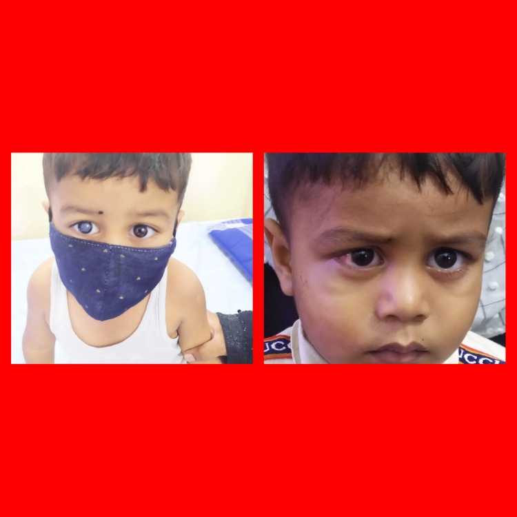 Cataract-6